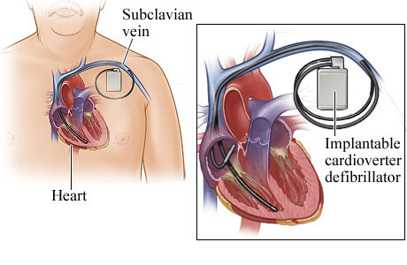 pacemaker surgery